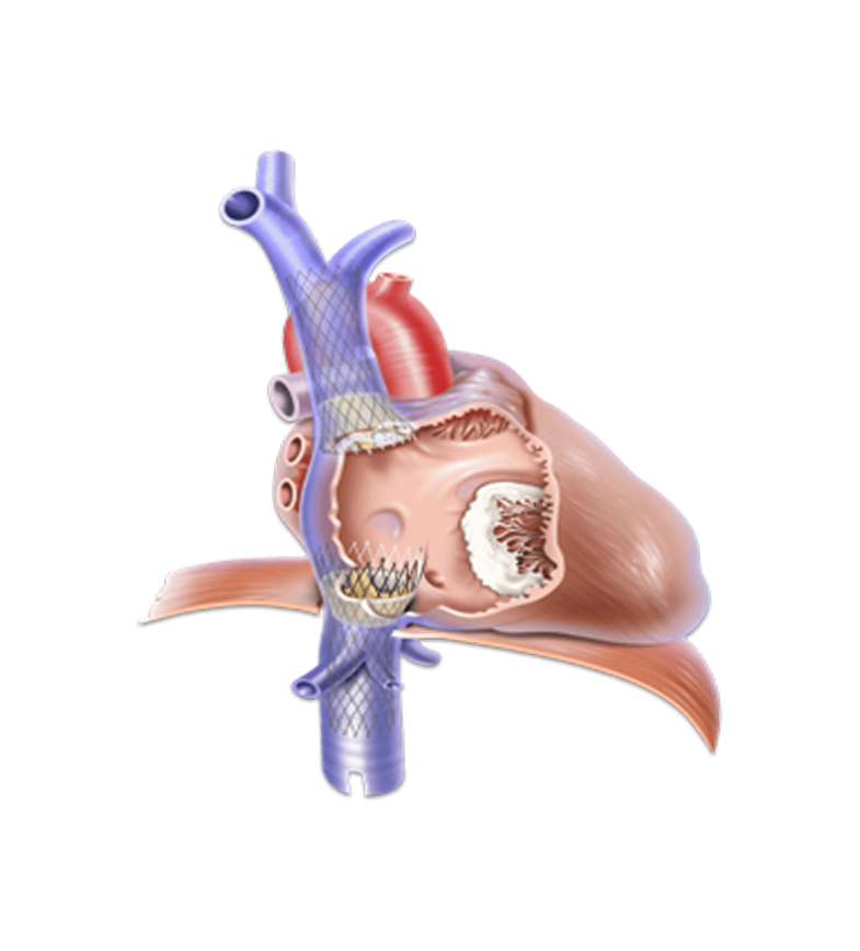 The TricValve System